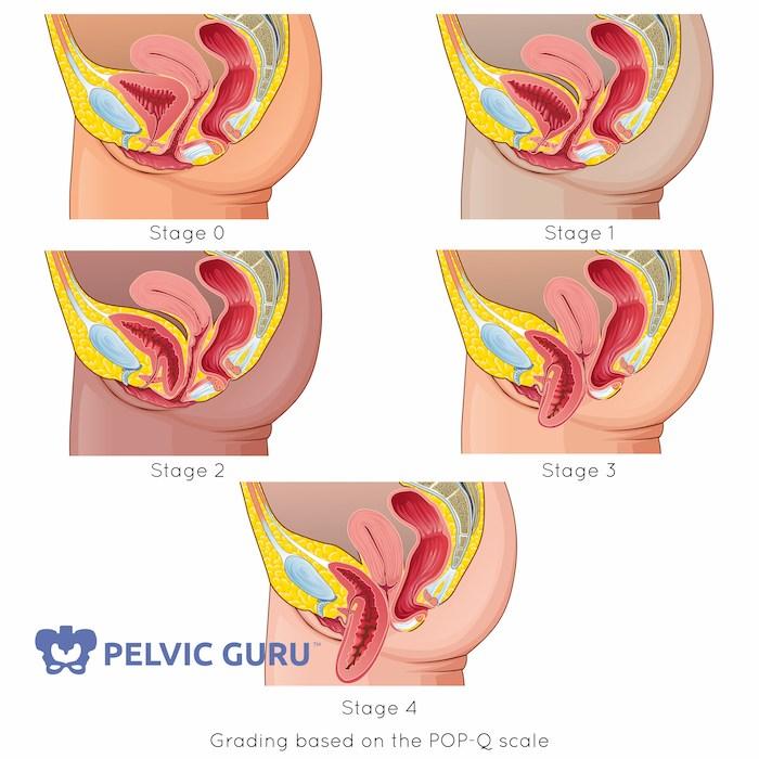 Pelvic Pain During Menopause