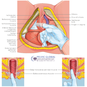 Vaginal examination with gloved finger of lateral pelvic floor musculature from an external view with cross sections perfect to determine vaginismus
